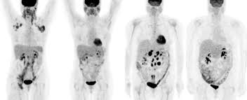 First Prostate Cancer Patients Imaged With Axumin Fluciclovine F 18 Tracer At Atlanta S Northside Hospital Imaging Technology News