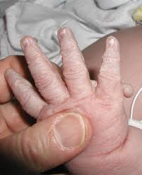 Image result for Polydactyly