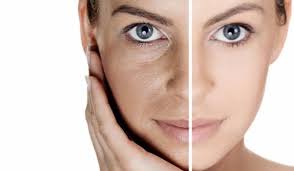 Radio-frequency skin tightening for youthful skin