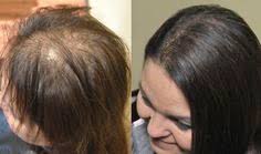 There are many great haircuts for men with thin hair as well as for those with a receding hairline, and by choosing one, you'll be able to improve your appearance.in particular, short haircuts tend to suit thin hair best. 9 Best Thinning Hair Solutions Ideas Thin Hair Solutions Hair Hairstyles For Thin Hair