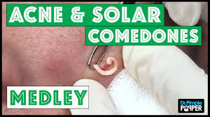 We did not find results for: A Drpimplepopper Comedone Medley All Softpops A Tbt Youtube