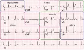 Bipolar Leads Ecg Lead Placement Normal Function Of The Heart Cardiology Teaching Package Practice Learning Divis Icu Nursing Nurse Paramedic School