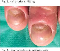 Image result for Pitting nails feet