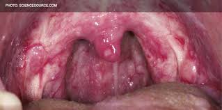 Image result for Pharyngitis