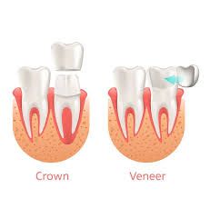 In fact, 36 percent of americans have no dental insurance. The Differences Between Dental Veneers Vs Dental Crowns