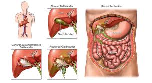 Ada banyak gejala dan faktor risikonya. Atiehilmi Com Malaysian Lifestyle Blogger Cara Singkirkan Batu Karang Dalam Hempedu Tanpa Pembedahan