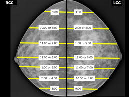Image result for Mammogram Interpretation