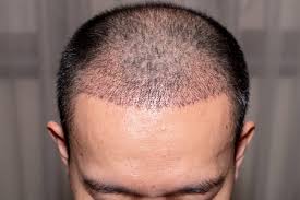Il s'agit d'une perte de cheveux temporaire, elle peut être saisonnière (à l'automne), avoir lieu après un accouchement ou un changement de pilule chez la femme ou encore après une forte fièvre… Greffe De Cheveux Que Faut Il Savoir Wk Pharma Fr