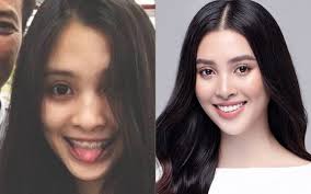 Quá khứ đeo niềng sắt, loạt cô gái vụt sáng thành Hoa hậu: Ý Nhi, Lê Hoàng  Phương là minh chứng