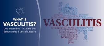 Image result for Vasculitis