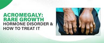 Image result for Acromegaly