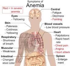 Image result for Anemia
