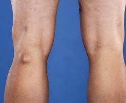 Ciri utama dari osteoarthritis sendiri adalah nyeri pada sendi, bengkak pada sendi, serta kekakuan pada. Tak Hanya Ada Di Rahim Ini 7 Jenis Kista Yang Sering Tumbuh Di Tubuh Dan Perlu Diketahui
