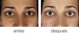 Eliminando Las Ojeras Oscuras Con Nanograft Blog Dr Jorge Planas