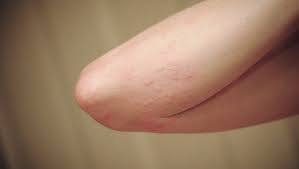 Discoid lupus causes a red rash that. Top 12 Home Remedies For Lupus Rash Lupus Rash Home Remedies For Rashes Natural Remedies For Lupus