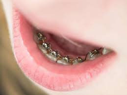 Raten zahnärzte zu einem besuch beim kieferorthopäden, löst das bei eltern viele fragen aus. Geldverschwendung Bei Zahnspangen Gesundheit