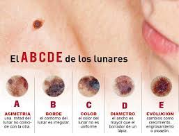 Las primeras manifestaciones de los síntomas de cáncer de piel, a menudo pasan desapercibidas. El Cancer De Piel Servicios Sad