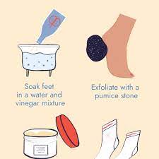 How To Heal Cracked Heels