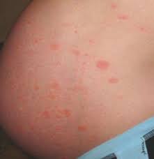 Image result for pruritic urticarial papules and plaques of pregnancy