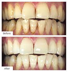 Dental Cleaning Brooklyn Deep Teeth Cleaning Cost Brooklyn Ny