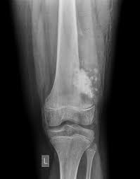 Image result for Osteosarcoma