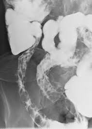 Some aphthoid ulcers may enlarge and deepen, producing a stellate or rose thorn appearance. Epos
