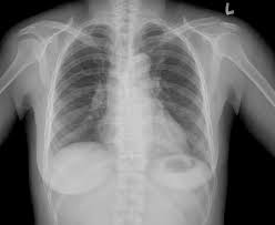 What is the meaning of apico abbreviation? Chest X Ray There Is No Evidence Of Parenchymal Infiltrates Or Mass Download Scientific Diagram