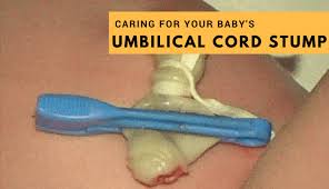 Feb 26, 2018 · do not immerse the baby in a bath until the cord has fallen off; How To Take Care Of Your Baby S Umbilical Cord Stump Maternity Nest
