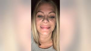 Connecticut mom 'feels ugly and unattractive' after plastic surgeries left  her with lumpy lips, misshapen nose