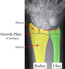 Image result for Hand Growth Plates