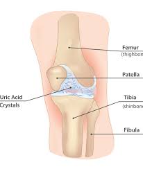 Image result for gout symptoms knee