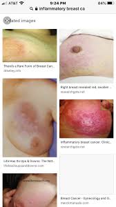 When the skin of the breast looks like the dimpled skin of an orange, this is a symptom of breast cancer known as peau d'orange, (how the french say orange peel). What Is The Difference Between Puckering Tethering And Dimpling In The Breasts During Breast Cancer Quora