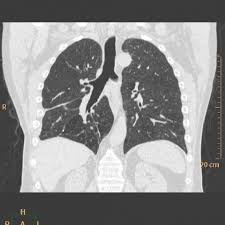 Image result for Broncholithiasis