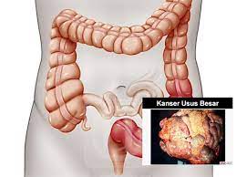 Kanser usus adalah kanser ketiga tertinggi di kalangan pesakit di malaysia! Ini Tanda Tanda Awal Penyakit Kanser Usus Yang Perlu Anda Beri Perhatian Serius