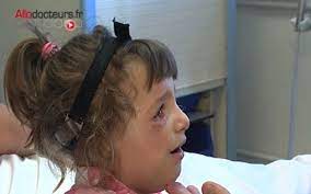 Überprüfen sie die übersetzungen von 'franceschetti syndrome' ins deutsch. Dysplasies Oto Mandibulaires Des Malformations Faciales Rares