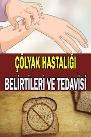Colyak Hastaligi Belirtileri Nelerdir Nasil Tedavisi Edilir Saglik Saglik Ipuclari Saglik Urunleri
