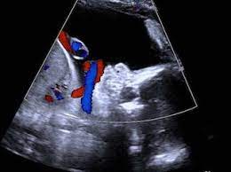 What Happens If The Umbilical Cord Is Around My Baby S Neck Your Pregnancy Matters Ut Southwestern Medical Center