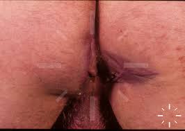 DermaCompass - Hidradenitis suppurativa