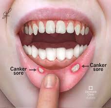 Image result for Mouth ulcers symptoms roof of the mouth