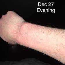 Inflammation or scarring is not usually present. Diagnose Me Arm Hair Loss And Rash Album On Imgur