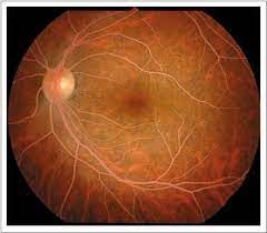 Eyedolatry Cholesterol And The Eye Spots In Eyes Eye Health Cholesterol