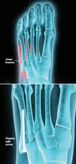 A jones fracture is a fracture at the base of 5th metatarsal (the long bone on the outside of the foot). Jones Fracture Fixation Central Coast Orthopedic Medical Group