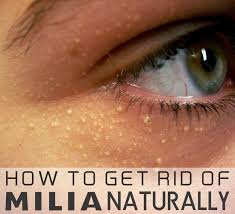 We Will Discuss The Ways Of How To Get Rid Of Milia On The Face And Under Eyes Which Is Also A Skin Proble Skin Problems Natural Skin Care Sensitive Skin