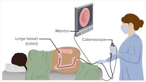 Image result for Colon Cancer Screening with Colonoscopy