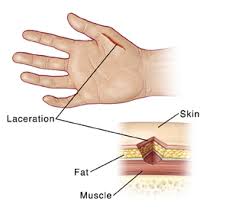 If the cut is still bleeding after 10 minutes of pressure, then it's important to seek medical care as soon as possible. Hand Laceration With Possible Nerve Injury Stitches Or Skin Glue