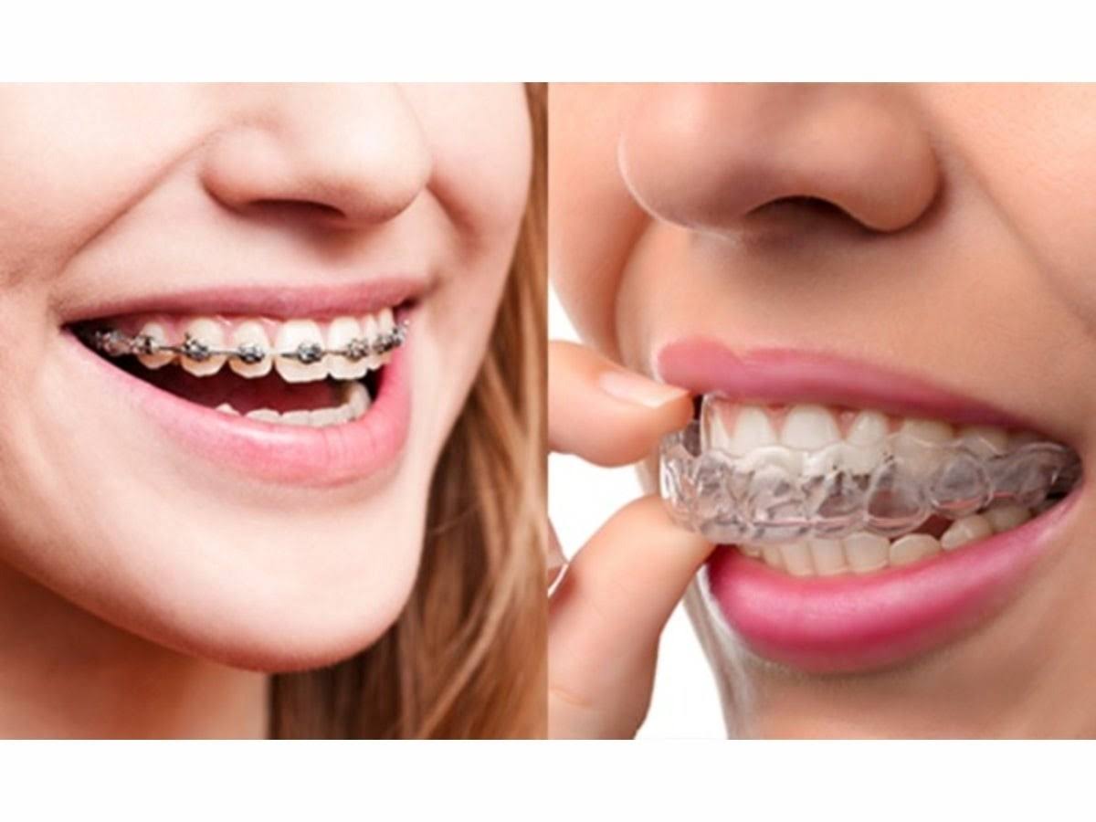 Braces/ Invisible aligners product image