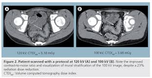 This improved confidence in our understanding of the lifetime cancer risks. Radiation Dose Reduction In Computed Tomography Techniques And Future Perspective