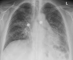Das programm scannt alle netzwerkgeräte, ermöglicht ihnen den zugriff auf freigegebene. Pulmonale Komplikationen In Der Chemotherapie Springerlink