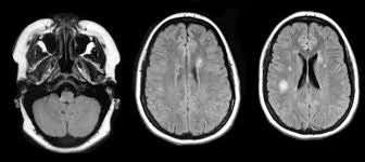 Image result for Brain Lesion