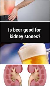 Is There A Connection Between Beer And Kidney Stones Kidney Health Nutrition Health Drinking Beer